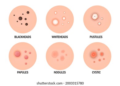 Tipos de acné establecidos. Enfermedad cutánea, dermatología, concepto cosmetológico. Infografías médicas. Afiche científico. Pancarta panorámica con información útil. Ilustración vectorial aislada en fondo blanco.