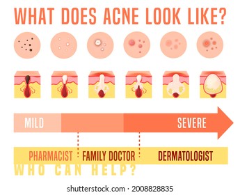 Tipos de acné establecidos. Enfermedad cutánea, dermatología, concepto cosmetológico. Infografías médicas. Afiche científico. Pancarta panorámica con información útil. Ilustración vectorial aislada en fondo blanco.