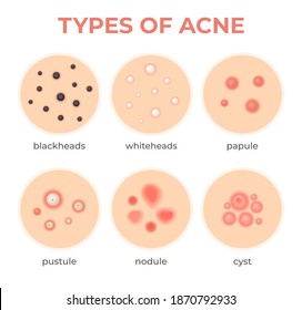 347 Acne formation Images, Stock Photos & Vectors | Shutterstock
