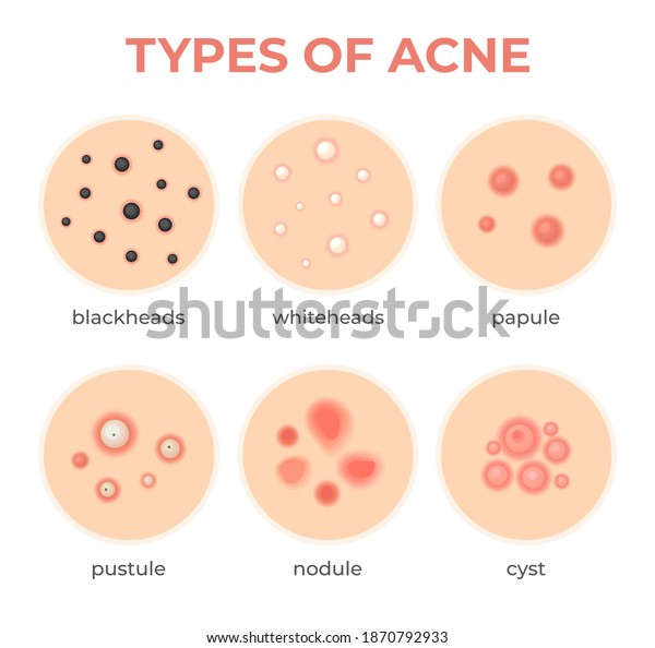 Acne types. Skin infection problem, pimples\
grade and type cyst, whitehead, blackheads, nodule and cystic.\
Dermis pore disease vector set. Facial inflammation, medical\
treatment and healthcare