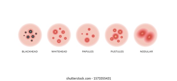 Acne types, skin pimples blackheads and face comedones. Vector icons of skin acne pimples, cosmetology and skincare problems
