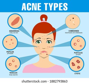 Acne types, skin pimples blackheads and face comedones. Infographics of acne. Girl with types of acne. Skin acne pimples, cosmetology and skincare problems.