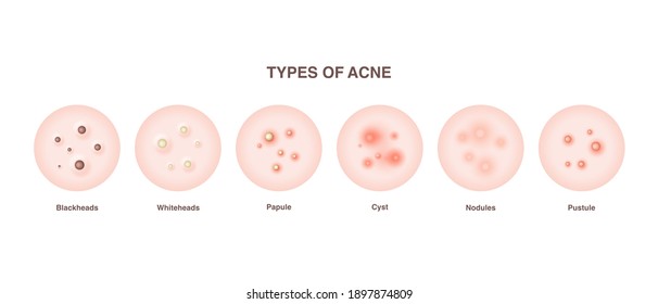 Acne types, skin pimples blackheads and face comedones. Types of acne diagram illustration vector