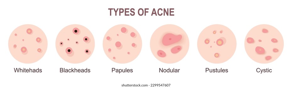 Acne types, skin pimples blackheads and face comedones. Skin acne pimples, cosmetology and skincare problems. Vector icon set