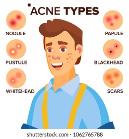 Acne Types Vector. Man With Acne. Facial Skin Problems. Papule, Pustulem Scards. Isolated Flat Cartoon Character Illustration