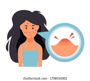 Acne. Unhappy girl with acne and pimples. Skin face irritation problem. Vector cartoon illustration.