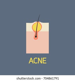 ACNE vector icon illustration
