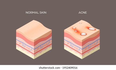 acne vulgaris or pimple and normal skin cross-section of human skin layers structure skincare medical concept flat horizontal