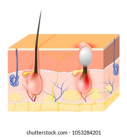 acne vulgaris bilder