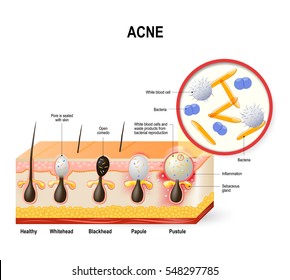 Acne vulgaris or pimple. The sebum and dead skin cells in the clogged pore promotes the growth of a certain bacteria. This leads to the redness and inflammation associated with pimples. skin disease