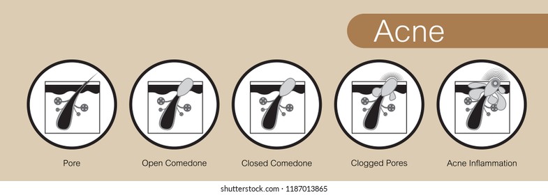 Acne,stages of development,healthy skin,vector design