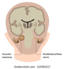 Acoustic Neuroma