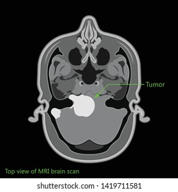 Acoustic Neuroma ear exam diagnose nerve treat noncancerous balance therapy