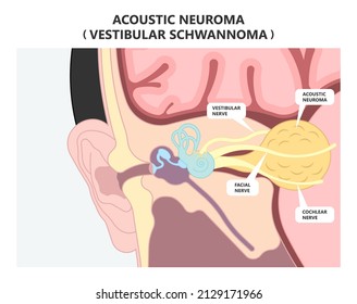 Acoustic Neuroma ear exam diagnose nerve treat noncancerous balance therapy