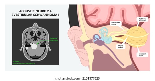 Acoustic Neuroma ear exam diagnose nerve treat noncancerous balance therapy