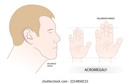 acromegaly giant enlargement body with Insulin like Factor hormonal