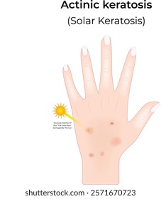 Actinic Keratosis Science Design Vector Illustration Diagram