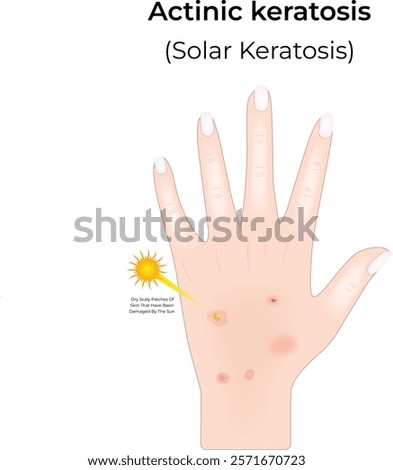Actinic Keratosis Science Design Vector Illustration Diagram