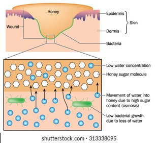 The action of honey on bacterial growth, reducing wound infection by osmosis