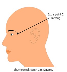 Acupuncture extra point 2 that is also known as Taiyang