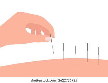 Acupuntura com agulha. Medicina alternativa. Terapia corporal e spa, bem-estar e acupressão. Ilustração vetorial