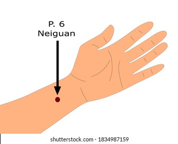 acupuncture point Pericardium 6 (P. 6) that is also known as Neiguan 