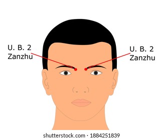 Punto de acupuntura Vejiga urinaria 2 ó U.B. 2 que también se conoce como Zanzhu