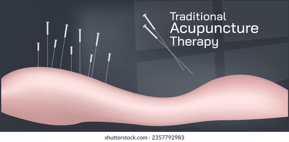 Acupuncture is the practice of penetrating the skin with thin, solid, metallic needles which are then activated through gentle and specific movements of the practitioner's hands vector illustration.