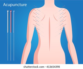 acupuncture treatment vector , women back skin