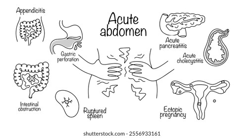 Acute abdomen. A pathological condition of the body in which serious damage to the abdominal organs has occurred. hand drawn most common causes of acute abdomen. Medical vector illustration.