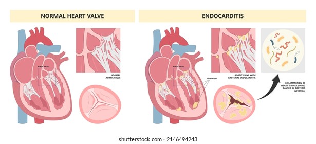 Acute aortic mitral valve bacteria fungi germs fever gum sepsis osler nodes insufficiency chest pain murmur sound palms hand skin rash nails eye roth spot