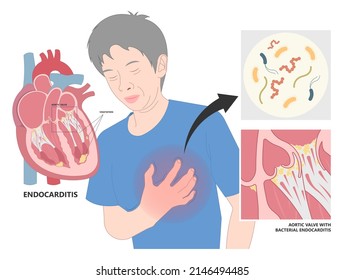 Acute aortic mitral valve bacteria fungi germs fever gum sepsis osler nodes insufficiency chest pain murmur sound palms hand skin rash nails eye roth spot