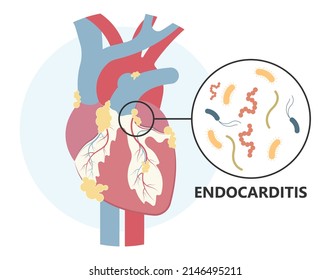 Acute aortic mitral valve bacteria fungi germs fever gum sepsis osler nodes insufficiency chest pain murmur sound palms hand skin rash nails eye roth spot