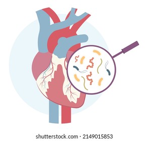 Acute aortic mitral valve bacteria fungi germs fever gum sepsis osler nodes insufficiency chest pain murmur sound palms hand skin rash nails eye roth spot