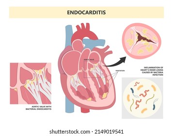 Acute aortic mitral valve bacteria fungi germs fever gum sepsis osler nodes insufficiency chest pain murmur sound palms hand skin rash nails eye roth spot