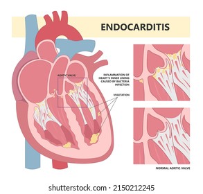 Acute aortic mitral valve bacteria fungi germs fever gum sepsis osler nodes insufficiency chest pain murmur sound palms hand skin rash nails eye roth spot