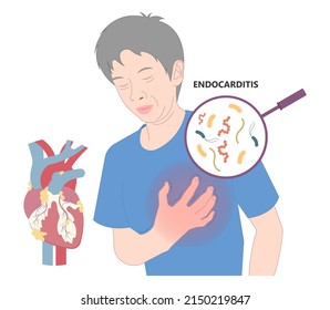 Acute aortic mitral valve bacteria fungi germs fever gum sepsis osler nodes insufficiency chest pain murmur sound palms hand skin rash nails eye roth spot