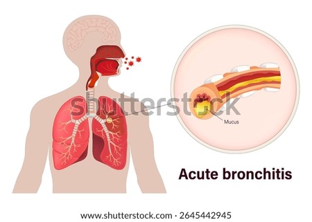 Acute bronchitis. Lung diseases. Caused by a viral infection. Human respiratory system.