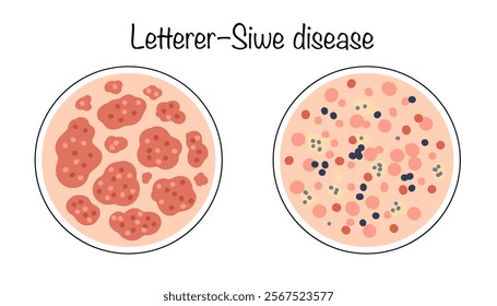 An acute form of histiocytosis X, characterized by the formation of foci of proliferation of atypical histiocytes on the skin. Drawn variants of the manifestation of the disease on the skin. Vector.