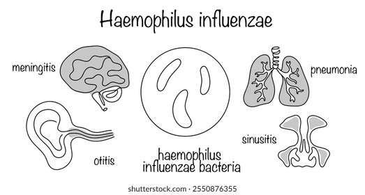 Eine akute Infektionskrankheit, die durch Haemophilus influenzae verursacht wird. Infektionen mit Haemophilus influenzae, die die Atemwege beeinträchtigen. Zeichnung des Krankheitserregers und der wichtigsten Symptome.