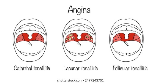 An acute infectious disease characterized by inflammation of the tonsils. Three main types of sore throat drawn by hand. Colored vector on a medical theme.