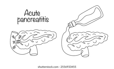 Acute inflammation that occurs suddenly and is accompanied by severe symptoms. The disease is caused by a blockage of the pancreatic duct from a gallstone or excessive alcohol consumption. Vector.