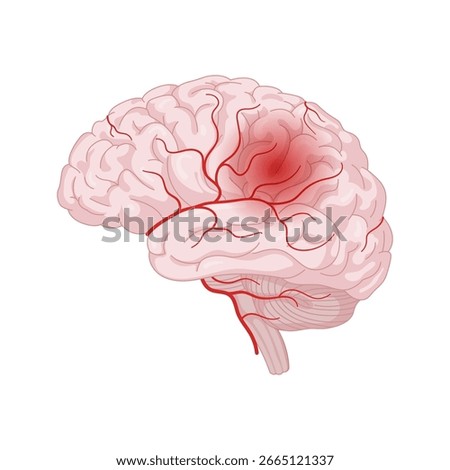 Acute Ischemic Stroke in the Brain due to Arterial Blockage
