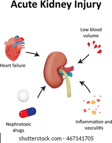 Acute Kidney Injury (AKI)