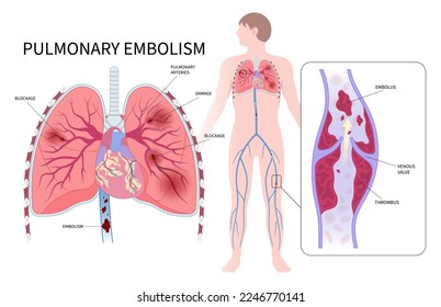 Trastorno del embolismo pulmonar con sección transversal de las venas de las arterias bloqueadas por coágulo sanguíneo alrededor de la pierna y el pulmón