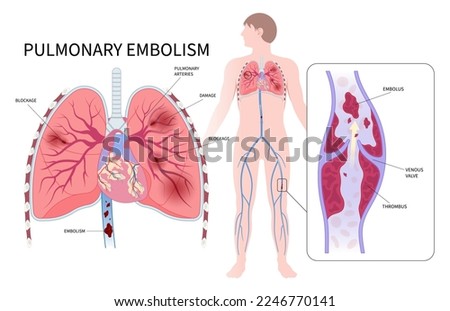 Acute limb ischemia with thrombus block arteries blood vessel chest pain edema clot chronic cough of lung air stroke spider vein high swelling knee ulcer leg foot calf post thrombotic