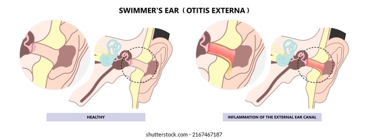 Comparación entre sanos e infecciones de canal auditivo que tienen pus y drenaje fluido