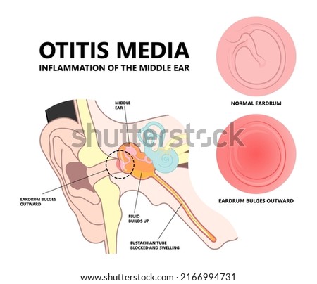 Acute Otitis Media air filled space eardrum treat pain fluid tube pus bacteria virus nasal cold flu drain swollen mastoid prevent diagnostic exam canal tool ENT Nose otalgia vertigo BPPV head wax test