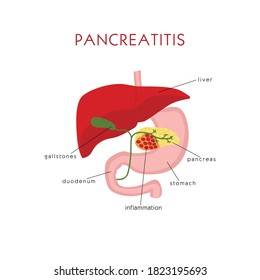 9,608 Pancreatitis Images, Stock Photos & Vectors | Shutterstock