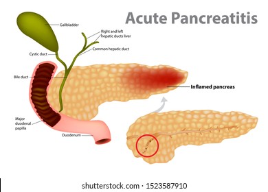 Acute Pancreatitis 图片 库存照片和矢量图 Shutterstock